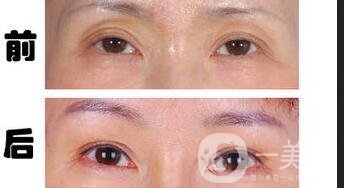 雙眼皮失敗修復(fù),雙眼皮失敗修復(fù)多少錢