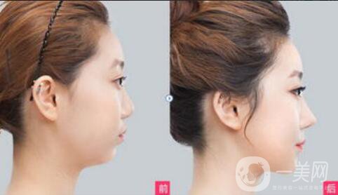 隆鼻注意事項(xiàng)