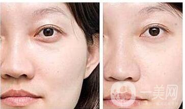 自體脂肪填充淚溝維持時(shí)間,自體脂肪填充淚溝價(jià)格