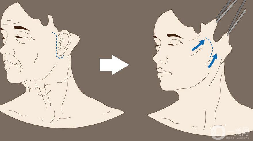拉皮手術(shù),拉皮手術(shù)術(shù)后護理