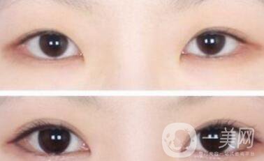 三點定位割雙眼皮多久恢復