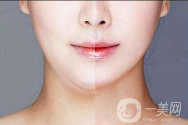 光纖溶脂雙下巴,光纖溶脂雙下巴價(jià)格,上海光纖溶脂雙下巴價(jià)格