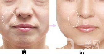 北京*去法令紋多少錢,*去法令紋多少錢,*去法令紋