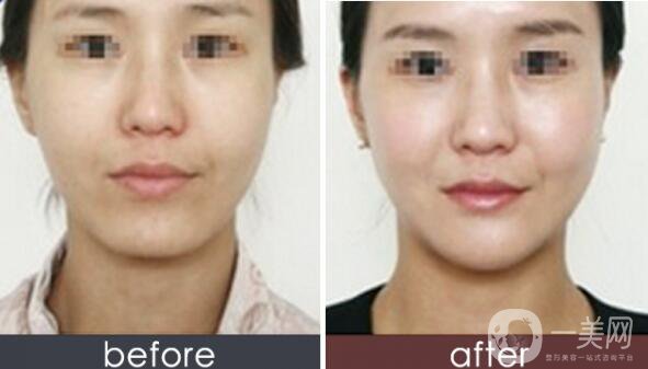 玻尿酸墊下巴,玻尿酸墊下巴注意事項(xiàng)