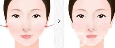 顴骨內(nèi)推*果維持時間,顴骨內(nèi)推術(shù)后護理方式