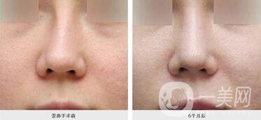 廣東歪鼻矯正手術費用,歪鼻矯正手術費用,歪鼻矯正手術