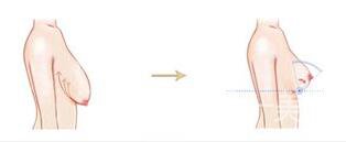 上海縮乳手術(shù)多少錢,縮乳手術(shù)多少錢