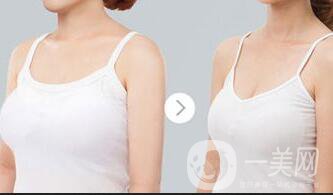 上?？s乳手術(shù)多少錢,縮乳手術(shù)多少錢