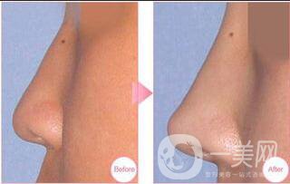 上海耳軟骨隆鼻多少錢,耳軟骨隆鼻,耳軟骨隆鼻多少錢