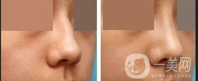 上海歪鼻矯正多少錢,歪鼻矯正多少錢,歪鼻矯正