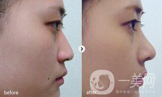 廣東自軟骨隆鼻多少錢