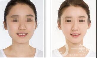 廣東射頻溶脂瘦臉價格,射頻溶脂瘦臉價格,射頻溶脂瘦臉