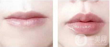 玻尿酸豐唇珠,玻尿酸豐唇珠注意事項