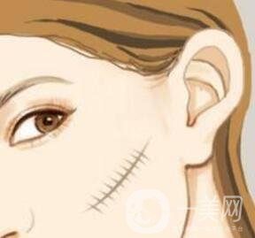 激光祛疤*果怎么樣？有什么優(yōu)勢(shì)