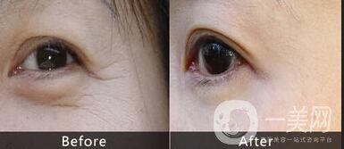 眼部熱瑪吉術(shù)后護理,眼部熱瑪吉