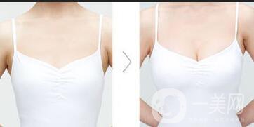 北京脂肪豐胸手術(shù)多少錢(qián)