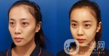 上海面部脂肪填充多少錢