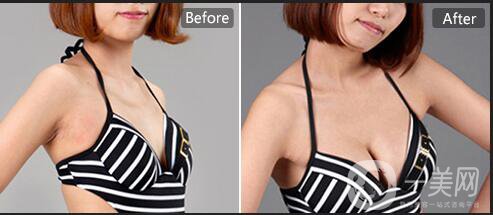 成都假體隆胸手術(shù)費(fèi)用