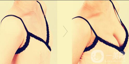 注射隆胸多少錢