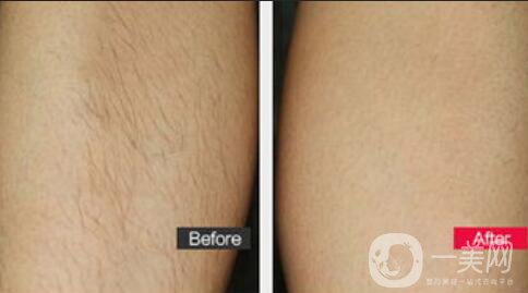 廣東冰點脫毛多少錢