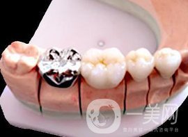 合金烤瓷牙和全瓷牙信息介紹