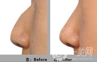 北京駝峰鼻矯正術(shù),價(jià)格