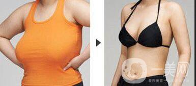 深圳大胸縮小手術(shù)多少錢