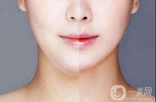 上海臉部抽脂多少錢(qián)