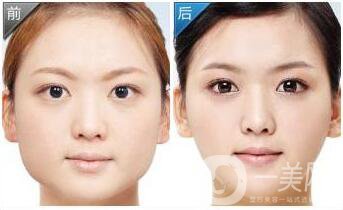 上海臉部抽脂多少錢(qián)