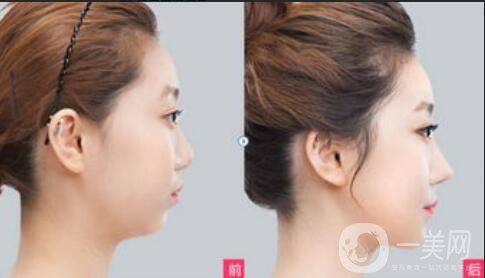 北京自體軟骨墊鼻多少錢(qián)