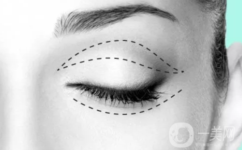 割雙眼皮一個(gè)月恢復(fù)情況