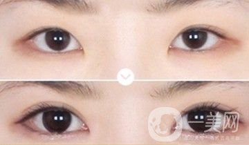 割雙眼皮一個(gè)月恢復(fù)情況