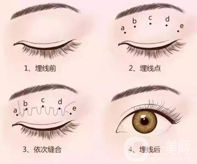 哪個(gè)割雙眼皮的方式比較好