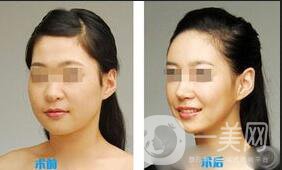 深圳臉部抽脂多少錢(qián)