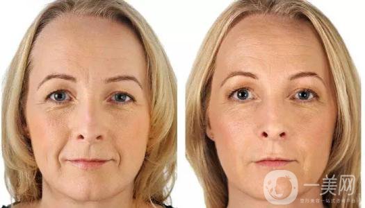 廣東做自體脂肪去法令紋的價格大概多少錢