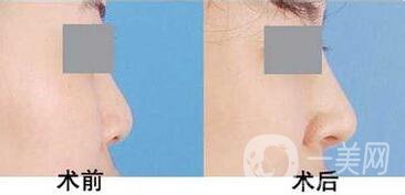 上海駝峰鼻矯正價錢