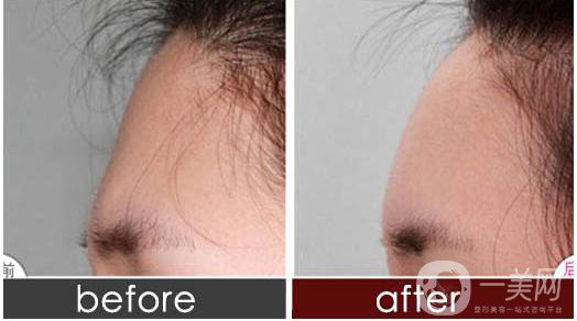 深圳自體脂肪豐額頭手術(shù)大概多少錢