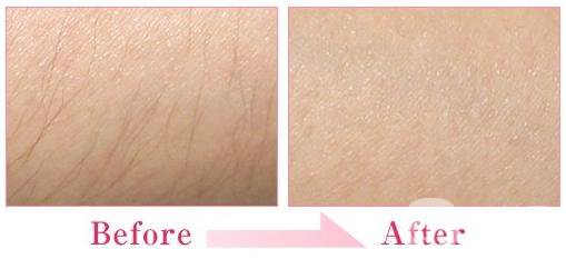 北京做冰點(diǎn)脫毛收費(fèi)情況 價格介紹