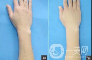 上海光子脫毛多少錢