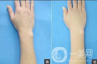 深圳光子脫毛收費