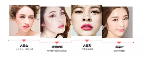 鼻翼縮小手術的價錢