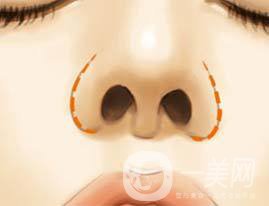 鼻翼縮小手術(shù)價錢 