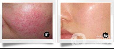 上海果酸嫩膚費(fèi)用