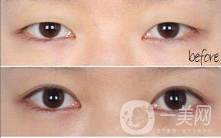 割雙眼皮術(shù)后護(hù)理