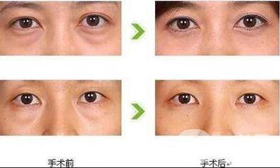 外切去眼袋修復(fù)價格