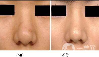 鼻翼縮小價格