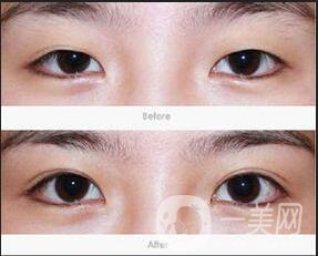 割雙眼皮術前檢查