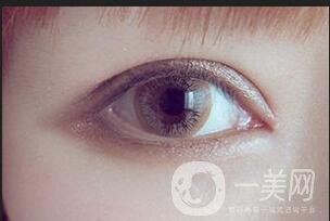 溶脂去眼袋修復價格