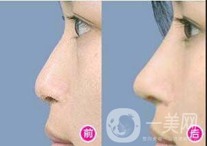 假體隆鼻整形價格