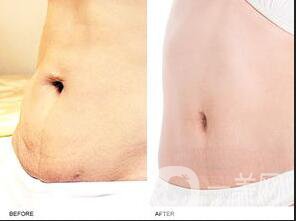 電波拉皮腹部整形,電波拉皮腹部整形*果